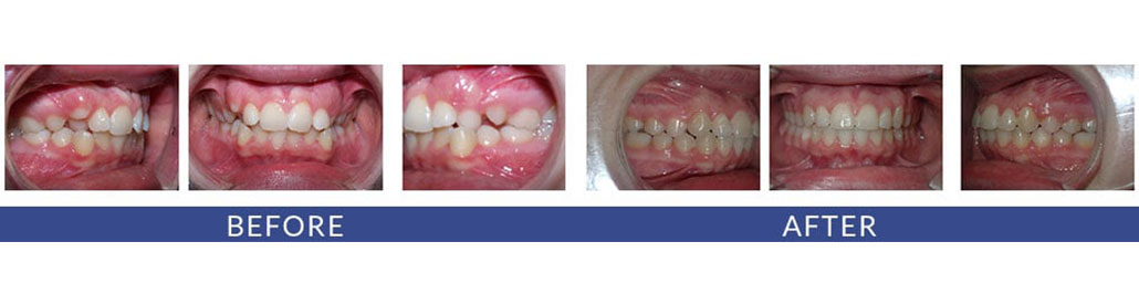 Eye Teeth Protruded in Adolescent Dentition