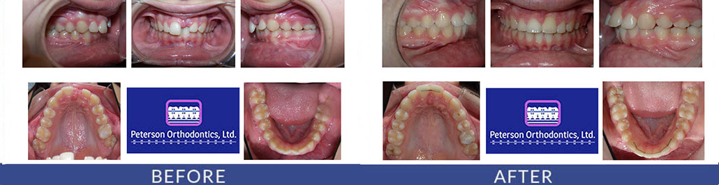 Impacted Upper Front Tooth