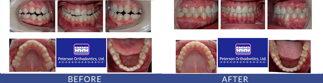 Underbite and Openbite